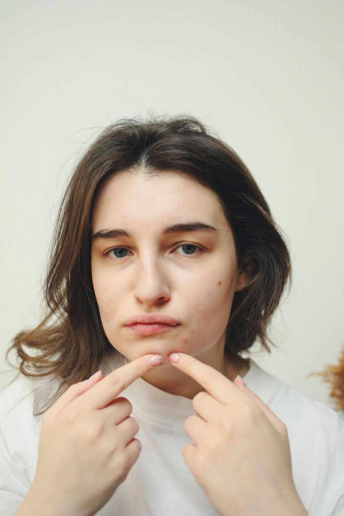 A young woman with acne examining a pimple on her cheek in a thoughtful expression. Une jeune femme atteinte d'acné examinant un bouton sur sa joue avec une expression réfléchie.